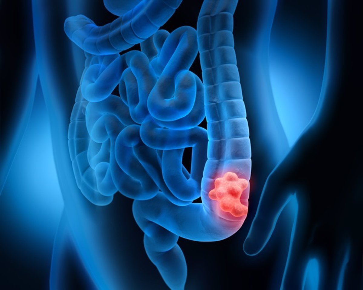 El trabajo por turnos y la iluminación "excesiva" están vinculados a un mayor riesgo de cáncer de mama, colon y próstata.