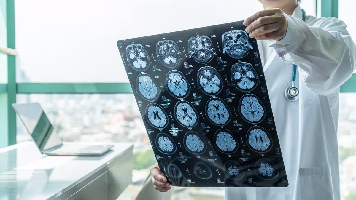 Identifican alteraciones en áreas cerebrales clave del Alzheimer en personas sanas con alta carga patológica en sangre