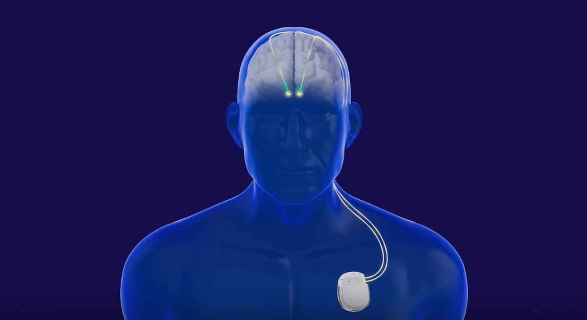 El Marañón, líder en el tratamiento del Parkinson mediante estimulación cerebral profunda al estilo de un marcapasos