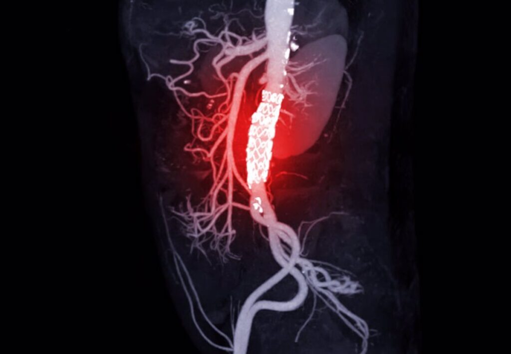 Inhibición de la enzima 'ACLY': Una técnica prometedora para frenar el avance del aneurisma de aorta abdominal