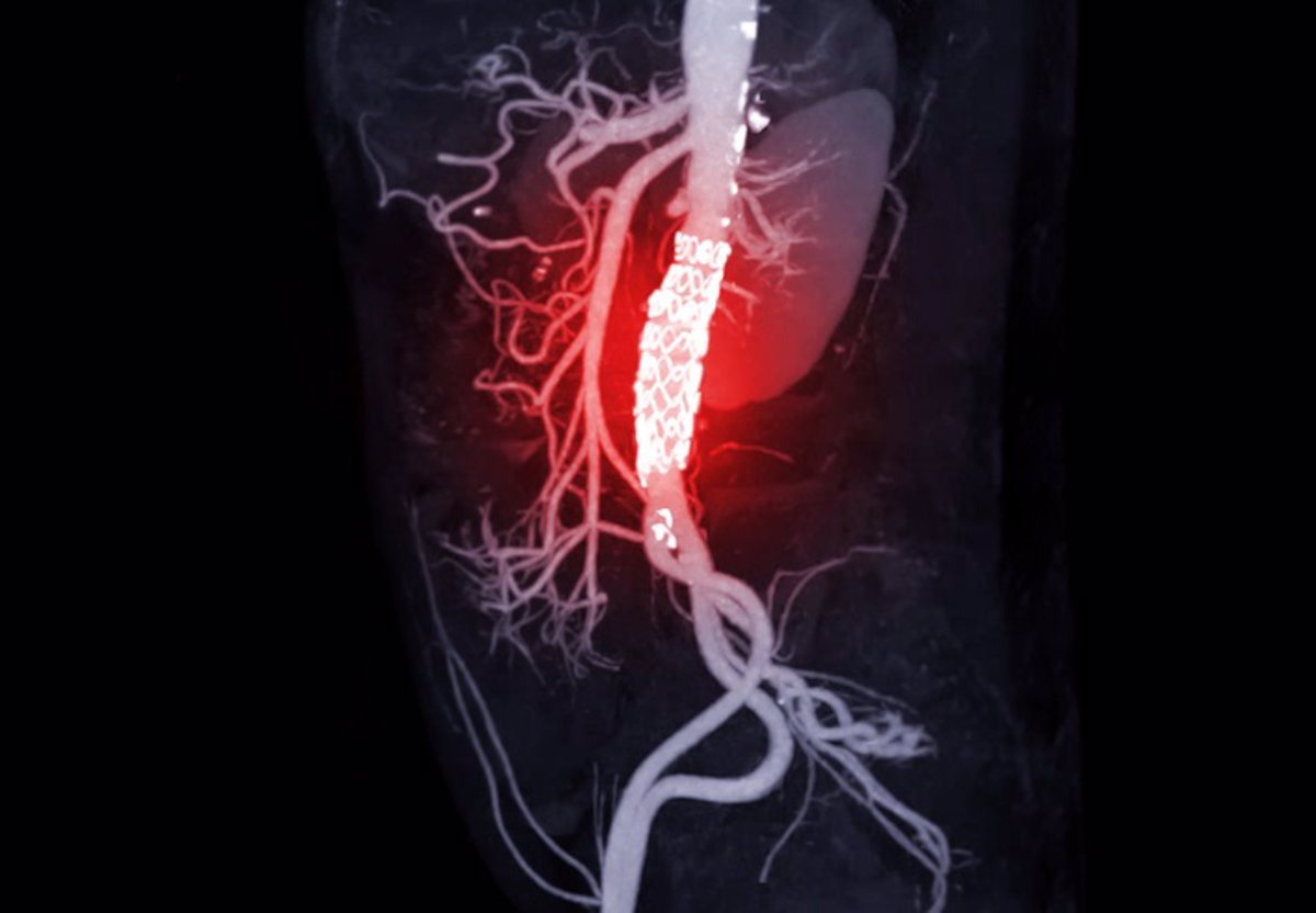 Inhibición de la enzima 'ACLY': Una técnica prometedora para frenar el avance del aneurisma de aorta abdominal