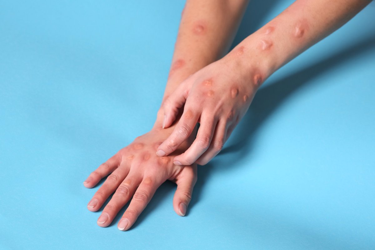 Los casos de mpox a nivel mundial disminuyen un 18,2% en febrero, según la OMS.