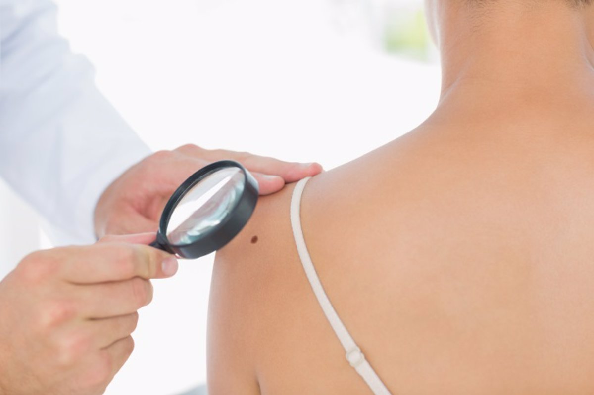 Revelan cómo el melanoma y otros tumores se camuflan para evadir la inmunoterapia