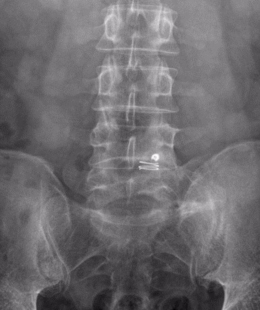 Un innovador dispositivo previene la reaparición de hernias discales en la zona lumbar