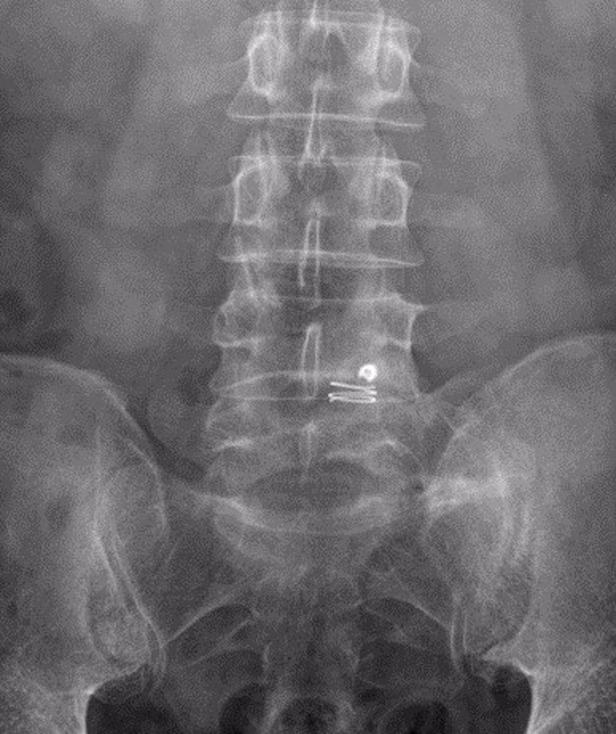 Un innovador dispositivo previene la reaparición de hernias discales en la zona lumbar