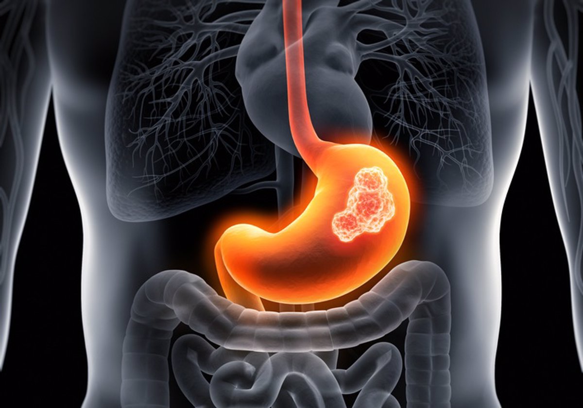 Un malestar digestivo persistente con síntomas adicionales puede indicar un riesgo de tumor gástrico