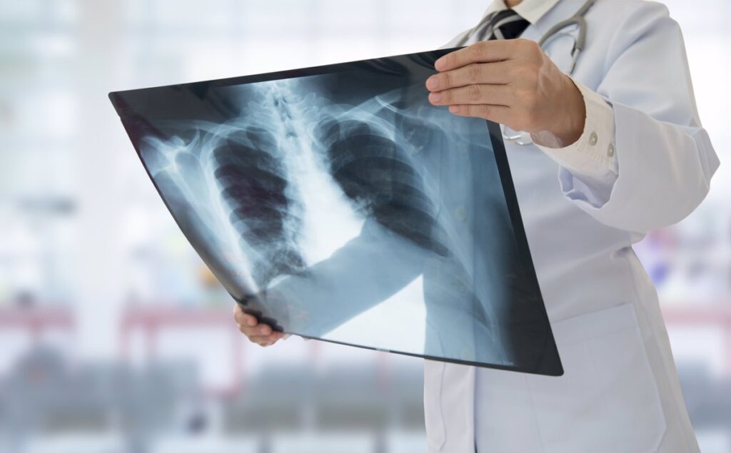 Aumento de la silicosis en España: 5.900 casos reportados desde 2007 y un récord de 520 en 2024.