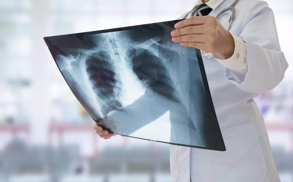 Aumento de la silicosis en España: 5.900 casos reportados desde 2007 y un récord de 520 en 2024.