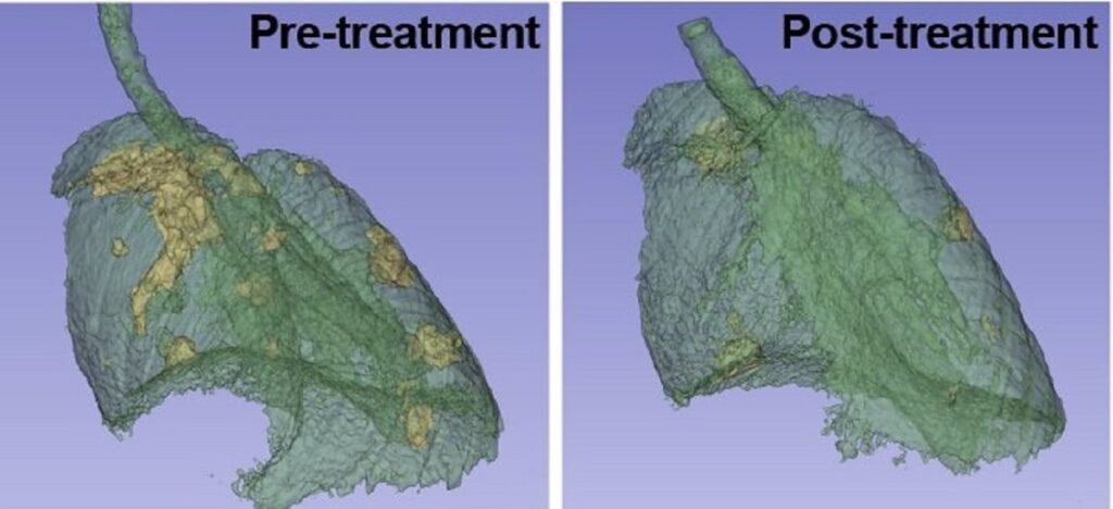 Descubren nueva diana terapéutica para el cáncer de pulmón más frecuente