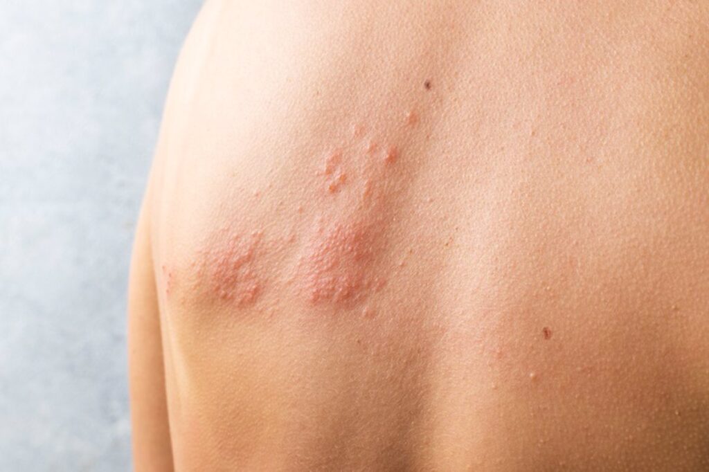 Investigadores de Stanford descubren que la vacuna contra el herpes zóster disminuye en un 20% el riesgo de demencia.