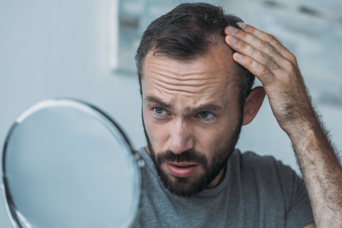 Confirman que un tratamiento para la alopecia puede provocar pensamientos suicidas.