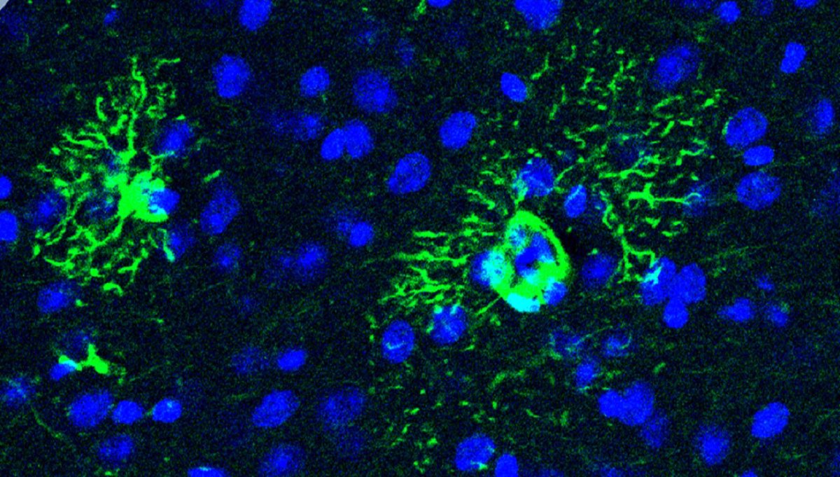 La acumulación excesiva de una proteína en el cerebro funciona como un "motor activo" del Alzheimer en sus primeras etapas.