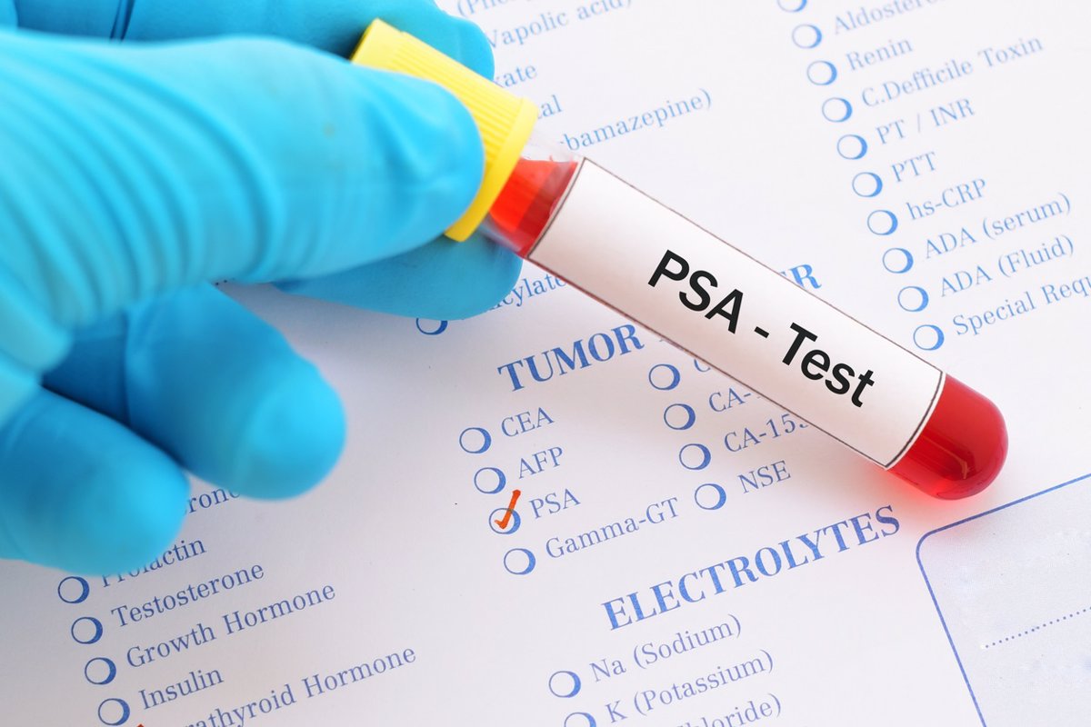 El cáncer de próstata con mutaciones en los genes BRCA1 y/o BRCA2 presenta un pronóstico más agresivo.