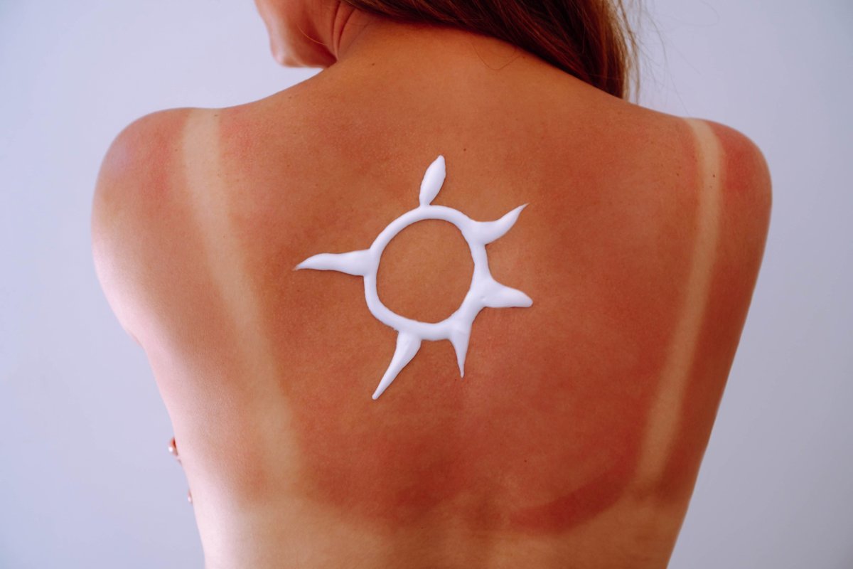 ¿Por qué algunas personas se broncean y otras se queman? 5 datos sorprendentes sobre la exposición al sol.
