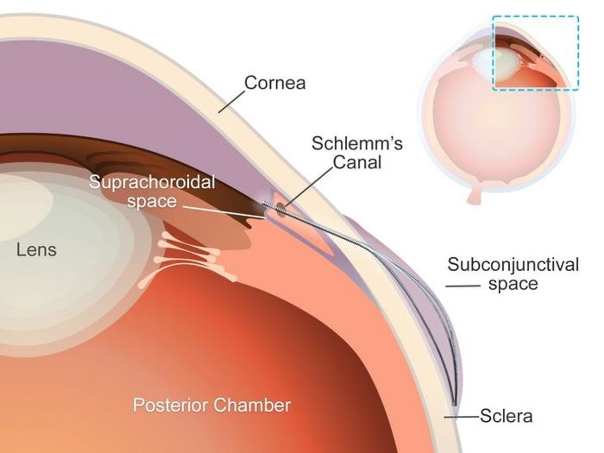 Crean un 'microstent' innovador para tratar el glaucoma.