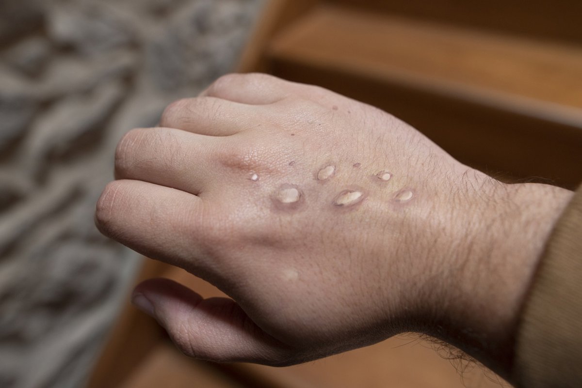 La OMS reporta más de 34,000 casos y 138 muertes por mpox a nivel mundial en 2025.