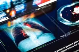 Un nuevo conjugado de anticuerpo y fármaco muestra resultados prometedores en un tipo de cáncer de pulmón.