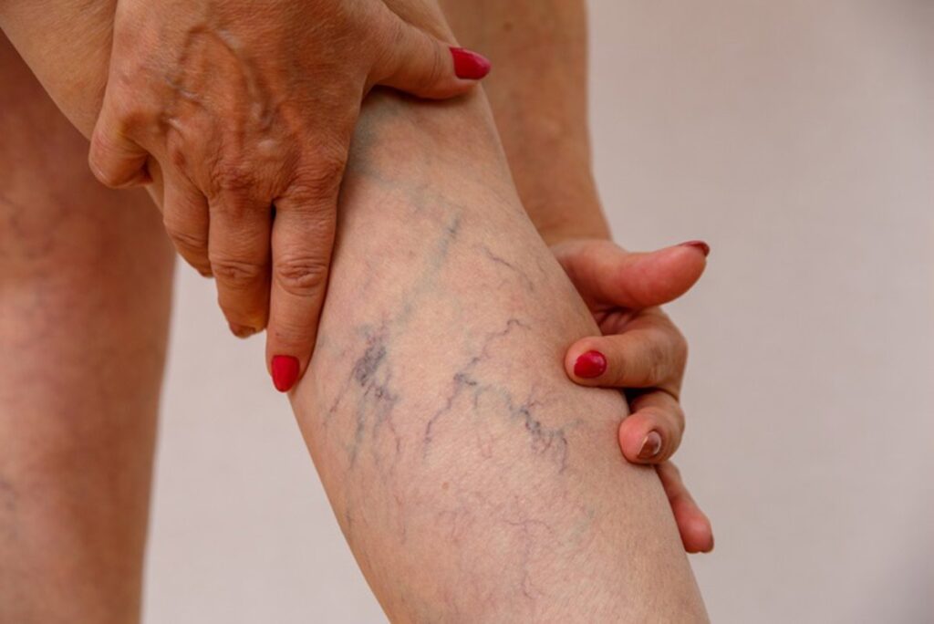 Varices y arañas vasculares: ¿solo un tema estético o un riesgo cardiovascular real?