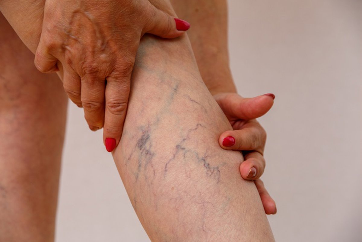 Varices y arañas vasculares: ¿solo un tema estético o un riesgo cardiovascular real?