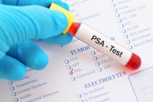 Expertos advierten sobre quiénes realmente deben hacerse la prueba de PSA