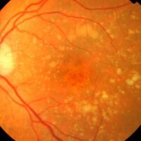 Un implante de retina recupera la visión central en pacientes con DMAE avanzada