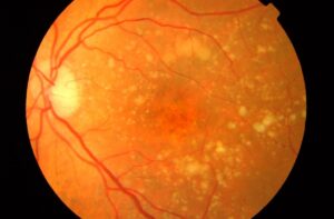 Un implante de retina recupera la visión central en pacientes con DMAE avanzada