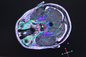 Descubren un vínculo entre enfermedades del cerebro e intestino que podría facilitar la detección del Parkinson.