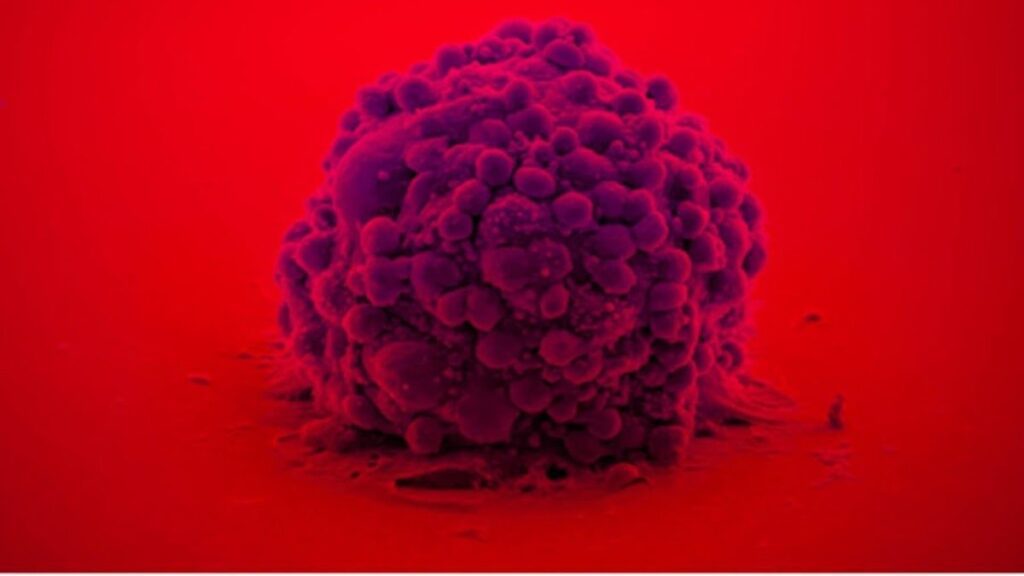 Crean un bioadhesivo inspirado en mejillones que destruye células del tumor cerebral más agresivo.