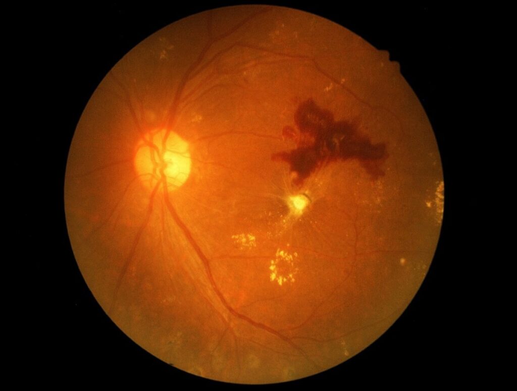 La retinopatía diabética muestra biomarcadores inflamatorios antes de que se produzcan daños oculares.