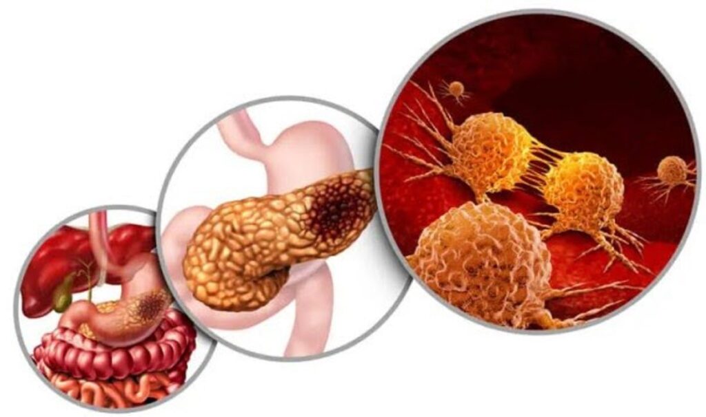 Desarrollan un nuevo medicamento con inhibidores duales para la lucha contra el cáncer de páncreas